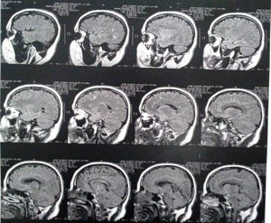 Brain magnetic resonance imaging of the case 3 years after the first psychiatry consultation.