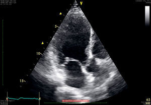 Two-chamber view; ventricular “ballooning” caused by apical dyskinesis observed.