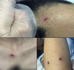 Superficial lesions and atrophic scars due to scratching on the frontal region, chest and forearm.