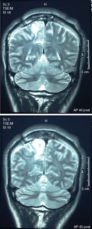 Magnetic resonance imaging of the brain (coronal plane in T2 without contrast) taken 4 months before the onset of the psychosis and 2.5 years after the surgical excision of the tuberculoma. The radiological report describes “large area of oedema with finger-like pattern in right frontal para-sagittal white matter.”