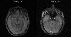 Magnetic resonance imaging. Supratentorial cortical subcortical atrophy is evident.
