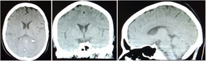 Simple cranial CT scan without evidence of intraparenchymal lesions. It is considered to be within normal limits.