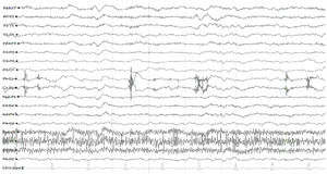 Electroencephalography trace. As noted in the text, a pattern suggestive of diffuse slowing (Hospital Universitario San Ignacio [San Ignacio University Hospital], 2017). Source: A. López, R Chavarría, G. Oviedo.