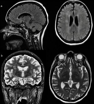 Magnetic resonance imaging of the brain. a) Sagittal and axial slices in FLAIR (fluid-attenuated inversion recovery) sequence where hyperintense "snowball" lesions are observed in the corpus callosum, corona radiata and periventricular regions. b) Coronal and axial sections in T2 sequence, showing loss of volume of hippocampal structures and hyperintensities in the corona radiata and basal ganglia.
