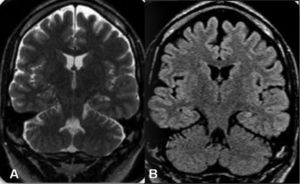 A: Enhanced T2 brain MRI, coronal section, with evidence of left hippocampal sclerosis. B: Enhanced FLAIR brain MRI, coronal section, with evidence of left hippocampal sclerosis.