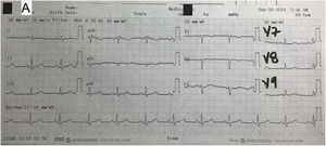 Electrocardiogram. Sinus rhythm and T wave inversion in leads V1–V2 with no signs of ischaemia.