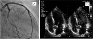 A: Coronary angiography showing no obstruction. B: Transthoracic echocardiogram showing mild diffuse hypokinesia in the medial and apical septal segments.