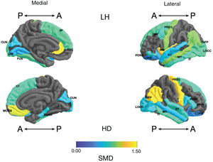Standardised mean difference (SMD) of the surface area of the cortical regions of interest in patients with type I bipolar affective disorder treated with lithium and without lithium, according to right (RH) and left (LH) hemispheres with anterior (A) and posterior (P) views. CMF: caudal middle frontal; CUN: cuneus; FUS: fusiform; INFP: inferior parietal; INS: insula; IT: inferior temporal; LIN: lingual; LOCC: lateral occipital; LORB: lateral orbitofrontal; MORB: medial orbitofrontal; MT: middle temporal; PARH: parahippocampal; POPE: pars opercularis; PORB: pars orbitalis; PREC: precentral; PTRI: pars triangularis; RAC: rostral anterior cingulate; SF: superior frontal; ST: superior temporal.