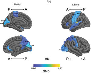 Standardised mean difference (SMD) of the thickness of cortical regions of interest in patients with type I bipolar affective disorder treated with lithium and without lithium, according to right (RH) and left (LH) hemispheres with anterior (A) and posterior (P) views. RAC: rostral anterior cingulate; PARC: paracentral lobule; PTRI: pars triangularis; PREC: precentral; ISTC: isthmus cingulate; SP: superior parietal; PSTS: postcentral; ST: superior temporal; TT: transverse temporal; CUN: cuneus; LOCC: lateral occipital; PCAL: pericalcarine; PCUN: precuneus.