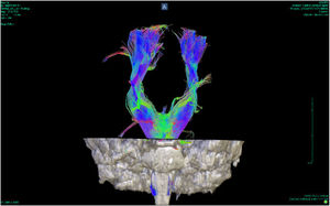 Corticospinal tractography of a patient with bipolar disorder (IATM-GIPSI).