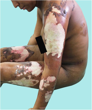 Patient A. Intermediate and deep second-degree burns on 18% of her total body surface area.