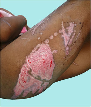 Patient A. Pattern of iron burns.