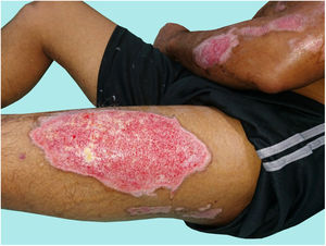 Patient B. Intermediate and deep second-degree burns on 11% of his total body surface area.