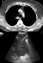 82-year-old patient with a solid lung lesion in the right upper lobe (a). The lesion was assessed by EUS-B-NA (b). Final diagnosis was lung adenocarcinoma EGFR positive.
