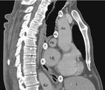 Sagital view of thorax CT with main acessible EUS-B lymph node stations (Ao – aorta, PA – pulmonary artery, LA – left atrium, L – liver).