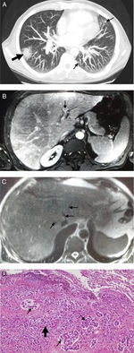 (A) Projection of maximum intensity in the computed tomography of the thorax. It shows a pulmonary nodule with ground glass halo and a small calcification (thick arrow) and several peripheral ground glass nodular lesions (thin arrows). (B) Thrombosis of the left portal vein on magnetic resonance imaging of the liver (sequence T1 with Gadolinium), (C) Narrow, but permeable, suprahepatic veins on magnetic resonance imaging of the liver (FSE T2WI sequence), (D) Micropapillary pattern lung adenocarcinoma (thick arrow) with marked vascular invasion (thin arrows). HE4× (haematoxylin eosin).