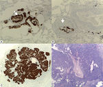 (A) Diffuse idiopathic pulmonary neuroendocrine cell hyperplasia: immunohistochemical stain (Chromogranin A 40×) demonstrating linear and nodular (arrow) neuroendocrine cell proliferation. (B) Constrictive bronchiolitis: immunohistochemical stain (Chromogranin A 100×) displaying a partial narrowing of bronchiole lumen (arrow) with linear hyperplasia of neuroendocrine cells. (C) Tumourlet: immunohistochemical stain (Chromogranin A 40×) revealing neuroendocrine cells proliferation, with spread into the peribronchiolar tissue, exhibiting a nesting pattern. (D) Typical carcinoid: low magnification photomicrograph (H&E 20×) of the medial segment of right middle lobe showing a tumour with an organoid pattern.