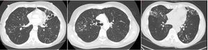 Nodular-bronchiectatic phenotypes of NTM. The CT images (left to right) show severe bronchiectasis in the Lingula in a patient with M. avium lung disease. Tree-in-bud is most easily visible in the right lung and the middle image shows this more clearly in the same patient. The right image shows a bilateral nodular bronchiectatic disease in a gentleman with M. abscessus infected.