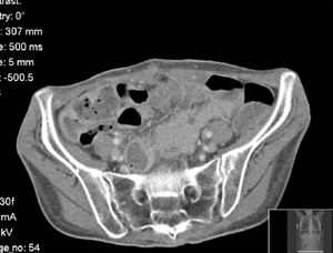 Abdominal CT: thickening of the wall of the ascendant colon, with abnormal contrast accumulation.