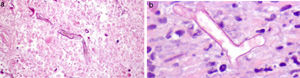 (a) and (b) Anatomopathological features: necrotic areas and hyphae with wall and vascular invasion.