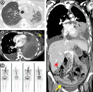 Restaging demonstrating disease progression. (A and B) Increasing of the lung mass and the extent of lymphangitic carcinomatosis; in the mediastinal images (B) a breast metastasis is observed (yellow asterisk). (C) Presence of multifocal bone metastasis. (D) Coronal reconstruction demonstrating progression of the lung mass, multiple hepatic nodules (red asterisk) suggestive to be metastatic, and peritoneal thickening with ascites (yellow arrow) compatible with peritoneal carcinomatosis.