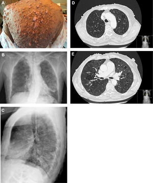 (A) Multiple cutaneous neurofibromas in a NF1 patient. (B, C) Chest X-ray in which thickening of the peribroncovascular interstice with left basal predominance is observed. (D, E) High resolution computed tomography (axial plane and pulmonary window) through upper lobes above and below carina showing multiple thin-walled irregular aerial cysts, that tend to converge in upper areas, with similar appearance to emphysema.