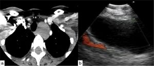 Bronchogenic cyst: (a) A CT scan of the chest showing a 30×26mm left paratracheal mass. (b) Anechoic appearance on EBUS as expected for a fluid containing cyst.