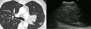 Angiosarcoma: a CT scan of the chest showing lobulated low attenuation mass situated 8mm distal to the bifurcation of the left pulmonary artery measuring 45×62×33mm, with its corresponding EBUS image.