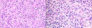 Inflammatory pseudotumor: spindle shaped cells in fascicles on a background of abundant inflammatory cells.