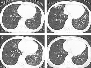 Chest computed tomography images at the time of diagnosis of gastric cancer (A); at 6 months (B) and 19 months (C) after gastrectomy; and at 2 months after the initiation of HFNC.
