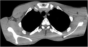 Thorax CT – showing left pectoralis muscle atrophy.