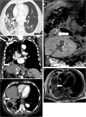 A: Axial cut computerized tomography. Pulmonary infiltrates patched with airborne bronchogram (thick arrow) and areas of tarnished glass predominantly right lower lobe (arrowhead). Figure 1B: Coronal cut computerized tomography. A small abscess is shown in the diaphragmatic region (thick arrow) and calcified hydatid cyst (arrowhead). Figure 1C: Axial cut computerized tomography. Abscess (thick arrow) between the posterior hepatic rim and the lower right lobe, with a small air bubble inside. Figure 1D: Coronal cut of hepatic magnetic resonance imaging in hepato-specific phase with bile duct contrast excretion at the same level as Figure 1B. Abscess (thick arrow) and fistulous path (thin arrow) are shown. Figure 1E: Axial cut of hepatic magnetic resonance imaging in hepato-specific phase with bile duct contrast excretion at the same level as Figure 1C. Fistulous tract (thin arrow) and abscess (thick arrow) leading to the anterobasal segment of the lower right lobe.