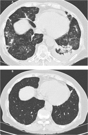 A Multiple small consolidations in both lungs with areas of ground glass opacification and small bilateral pleural effusion of left predominance. Fig. 1B. Complete resolution of the extensive pulmonary disease with consolidative component and ground glass, as well as the small bilateral pleural effusion.