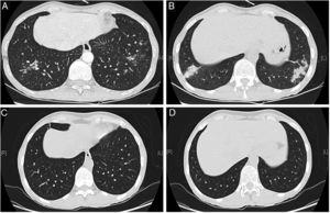 Chest computed tomography at diagnosis (A, B) and 8 months after treatment with steroids and clarithromycin (C, D). Peribronchovascular micronodules and dilated and thick-walled bronchioles with a fluffy tree-in-bud similar to “cotton-in-bud” present at diagnosis (A, B), resolved after treatment with steroids in association with 4 months of clarithromycin (C, D).