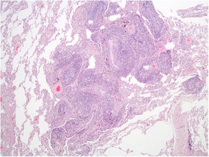 Hematoxylin and eosin-stained slide (40×) of patient's lung tissue, demonstrating hyperplastic lymphoid follicles with peribronchiolar germinal centers and bronchiole narrowing.