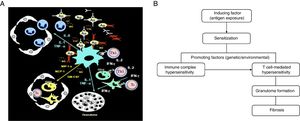 Pathogenesis of HP. (A) Classical immunopathological mechanisms proposed for HP (adapted from Delgado et al.96). The coexistence of genetic or environmental promoting factors leads to the development of an exaggerated immune reaction that results in marked lung inflammation. The generation of the granulomatous inflammation requires, among others, the expression of Th1 cytokines, including TNF-α, IL-12, and IFN-γ.18 (B) Persistent antigen exposure and sensitization associates with local antigen–antibody complex deposition, macrophage activation, mononuclear cell recruitment, and predominant Th1 cell-mediated response; continuous exposure leads to critical changes in the lung, ending in fibrosis.4,18.