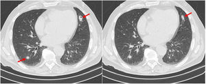 Chest computed tomography showing multiple pulmonary nodules (arrows) some of them with small cavitation areas, before corticosteroid treatment.