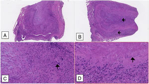 Temporal artery biopsy: (A and B) Cross section of arterial wall (haematoxylin–eosin 2.5×) showing luminal obliteration and more intense lympho-histiocytic inflammatory infiltrate in the intima and middle tunica (black arrows). (C) Multinucleated giant cell marked with a black arrow (haematoxylin–eosin 10×); (D) fragmented inner elastic blade (black arrow).