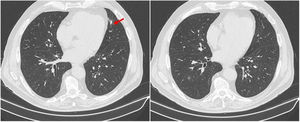 Chest computed tomography obtained 2 months after initiating steroid therapy. Resolution of the nodular lesions and marked fibrotic reaction around the healing residual lesions (red arrow) is evidence of a favourable response to treatment.