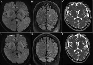 Brain MRI imaging of the patient on admission and after 9 days. A brain MRI upon admission showing a hyperintensity in the splenium of the corpus callosum in the diffusion weighted (DWI) (A) and fluid-attenuated inversion recovery (FLAIR) (B) imaging. The apparent diffusion coefficient (ADC) map confirmed the existence of this lesion (C). The pathology was completely reversible on day 9 after admission in the DWI (D), FLAIR (E) and ADC (F) imaging.