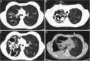 (A) Thoracic CT undertaken in 2010, where are identifiable cystic and cylindrical bronchiectasis more prominent in the right side. (B, C) Thoracic CT during hospitalization of the patient in 2011, showing pulmonary thick-walled cavities, with some material within the cavity, and also multiple new scattered nodular opacities, as well as some peripheral pleural based areas of consolidation. (D) Right sided hydropneumothorax.