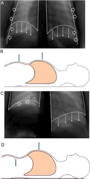 (A) Normal contraction of the diaphragm during quiet inspiration: the muscular action causes the diaphragm to move together like a piston in the caudal direction (direction of the arrows), thereby increasing abdominal pressure and decreasing pleural pressure. The latter is transmitted to the lung, causing it to be insufflated. (B) In supine position, it can be seen that both the rib cage and the abdomen move outwards. (C) When there is paralysis of the diaphragm (right side), the negative intrathoracic pressure drags the diaphragm and the abdominal viscera towards the thorax (direction of the arrows), which generates a negative abdominal pressure. (D) In supine position, it is observed how this negative abdominal pressure causes a paradoxical movement during inspiration: the abdomen moves inwards. (A) Normal contraction of the diaphragm during quiet inspiration: the muscular action causes the diaphragm to move together like a piston in the caudal direction (direction of the arrows), thereby increasing abdominal pressure and decreasing pleural pressure. The latter is transmitted to the lung, causing it to be insufflated. (B) In supine position, it can be seen that both the rib cage and the abdomen move outwards. (C) When there is paralysis of the diaphragm (right side), the negative intrathoracic pressure drags the diaphragm and the abdominal viscera towards the thorax (direction of the arrows), which generates a negative abdominal pressure. (D) In supine position, it is observed how this negative abdominal pressure causes a paradoxical movement during inspiration: the abdomen moves inwards.