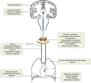 Causes of diaphragmatic dysfunction according to the level of involvement. Causes of diaphragmatic dysfunction according to the level of involvement.
