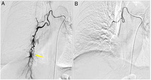 Description. Angiography preprocedure (A) shows hypertrophy of right bronchial artery and the presence of a fistula between bronchial artery and pulmonary artery. Angiography postprocedure (B) shows the absence of flood to pulmonary artery.