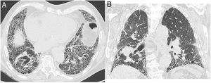 Patient with the CT diagnosis of definitive UIP. On the axial image (A) clearly the subpleural honeycombing is visible as well as traction bronchiectasis. On the coronal reformat (B) the apicobasal gradient is noted.
