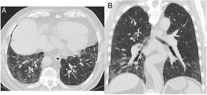 CT images with the features of probable UIP pattern. (A) displays subleural predominant interstitial changes without clear honeycombing. The coronal reformatted image (B) shows the apicobasal gradient of the pulmonary changes. Also traction bronchiectasis are present, also mild ground glass opacification.
