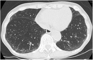 This CT images shows only minor subpleural interstitial changes, to be classified as “indeterminate for UIP”. To exclude a gravity dependency prone images were acquired showing the same changes. These changes show no honeycombing. Mild peripheral bronchiectasis are being noted indicative for a fibrotic component.
