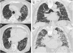 CT images in a case with an alternative diagnosis — in this case fibrosing NSIP. (A + B) show axial slices with interstitial parenchymal changes, but no honeycombing and marked ground glass opacification. Coronal reformats (C) show the distribution of the disease being more uniformly distributed between upper and lower lung areas. (D) shows a coronal CT image in expiration with sharply demarcated areas of air trapping.