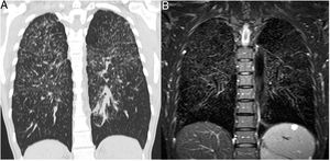 Patient with sarcoidosis, stage 2. (A) The CT image shows the typical nodular and interstitial parenchymal changes. (B) The corresponding coronal T2w SPAIR image shows the same typical pattern of lung parenchymal changes as CT. The normal lung areas remain dark due to the normal amount of air included.