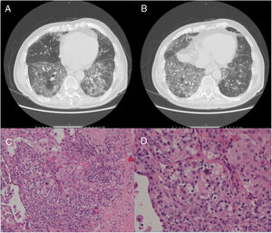(Panels A and B) CT scan images showing predominantly basal, bilateral, peripheral ground-glass opacities with associated reticular abnormalities consistent with a non-specific interstitial pneumonia (NSIP) radiological pattern. (Panels C and D) Histological appearance at different magnifications of transbronchial biopsies showing areas of organized fibrosis with fibrinous exudates and significant amount of inflammatory cells and with no evidence of malignant cells.